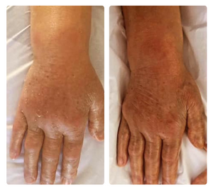 Soulagement immédiat