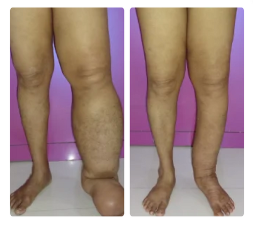 Jambe gonflée